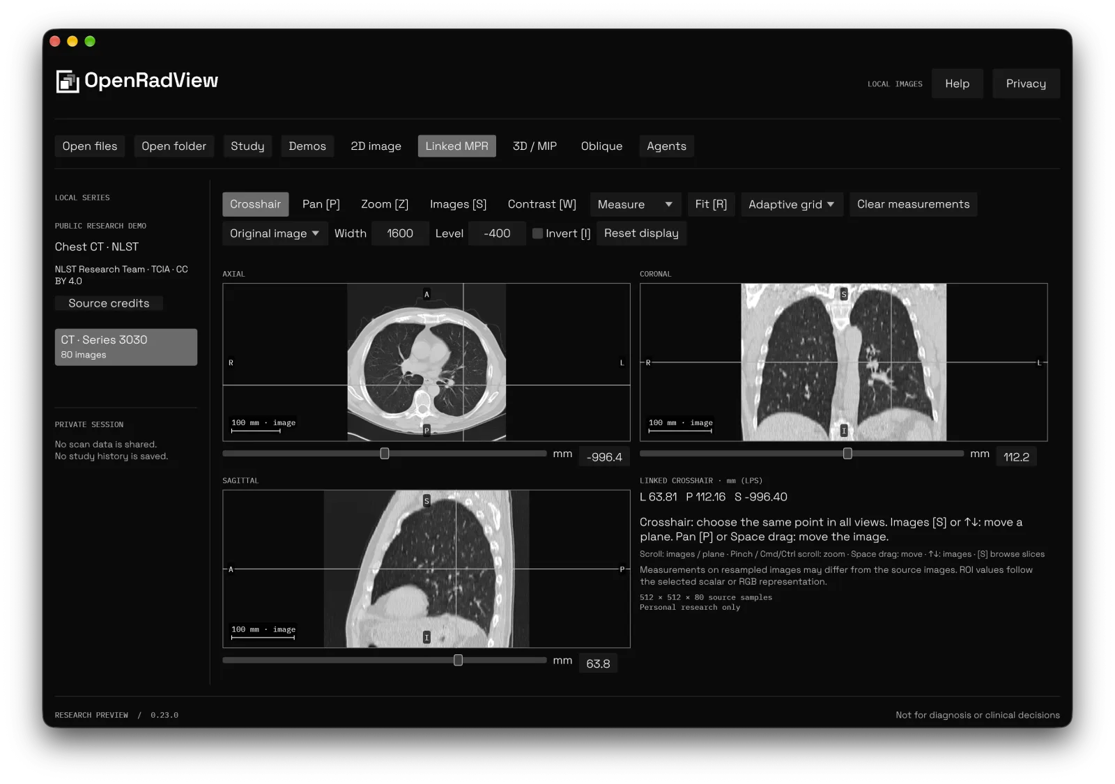 OpenRadView showing linked axial, coronal and sagittal views of a public chest CT